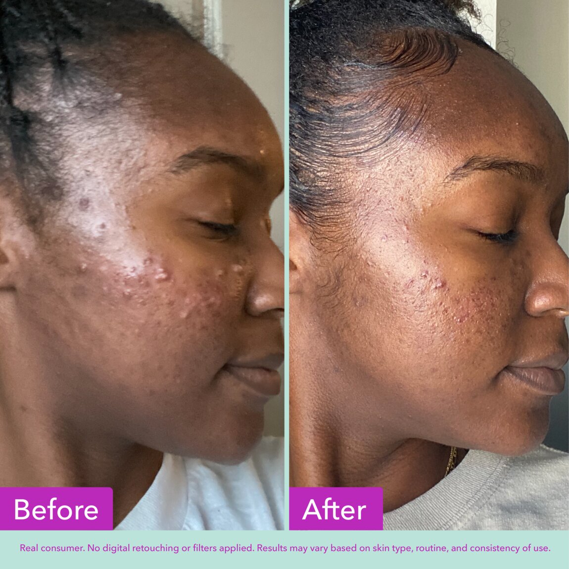 acne-foaming-cleanser-k8 zb_p.jpg
